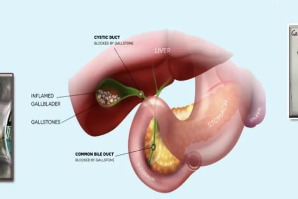 Cholecystectomy